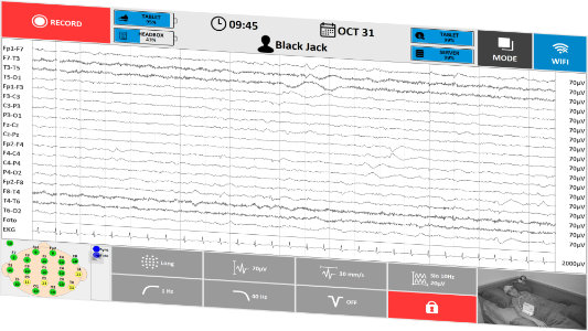 TruScan EEG Acquisition v režimu ICU